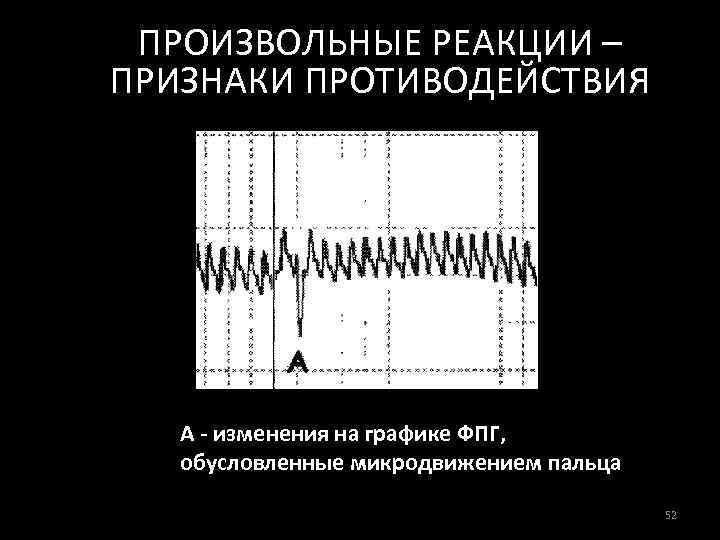 ПРОИЗВОЛЬНЫЕ РЕАКЦИИ – ПРИЗНАКИ ПРОТИВОДЕЙСТВИЯ А - изменения на графике ФПГ, обусловленные микродвижением пальца