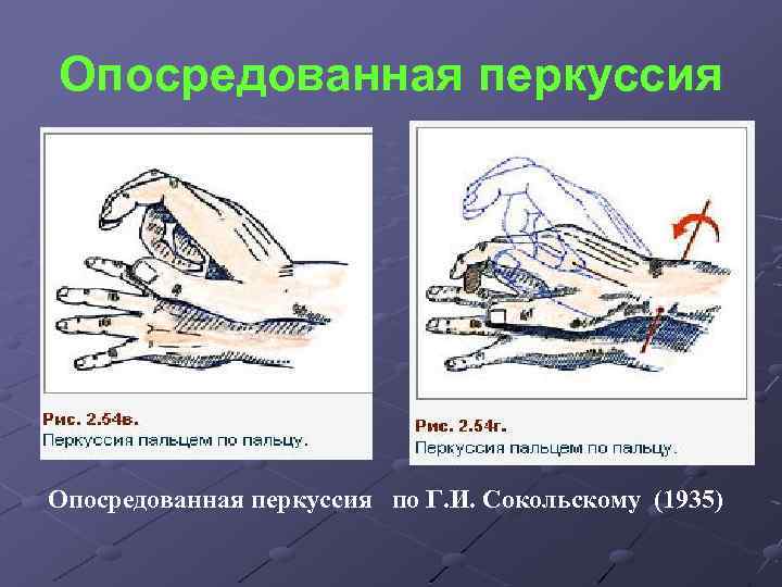 Опосредованная перкуссия по Г. И. Сокольскому (1935) 