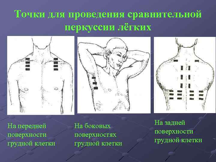 Точки для проведения сравнительной перкуссии лёгких На передней поверхности грудной клетки На боковых поверхностях