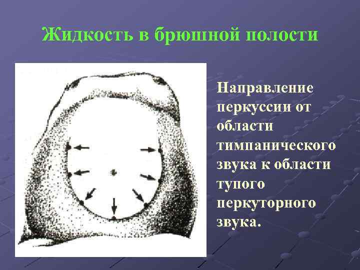 Жидкость в брюшной полости Направление перкуссии от области тимпанического звука к области тупого перкуторного