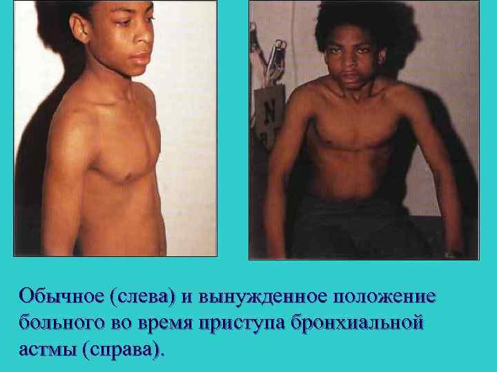 Обычное (слева) и вынужденное положение больного во время приступа бронхиальной астмы (справа). 