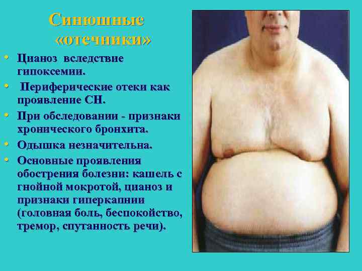 Синюшные «отечники» • Цианоз вследствие • • гипоксемии. Периферические отеки как проявление СН. При