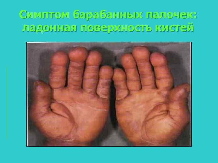 Симптом барабанных палочек: ладонная поверхность кистей 