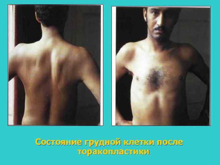 Состояние грудной клетки после торакопластики 