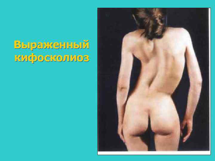 Выраженный кифосколиоз 