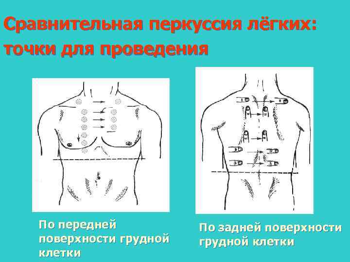 Перкуссия легких схема