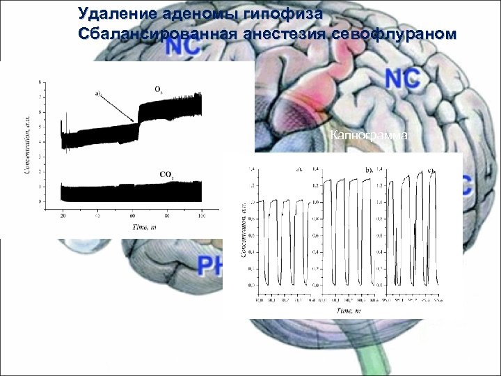 Удаление аденомы гипофиза Сбалансированная анестезия севофлураном Капнограмма Масс-спектрометрия для анестезиологии 39 