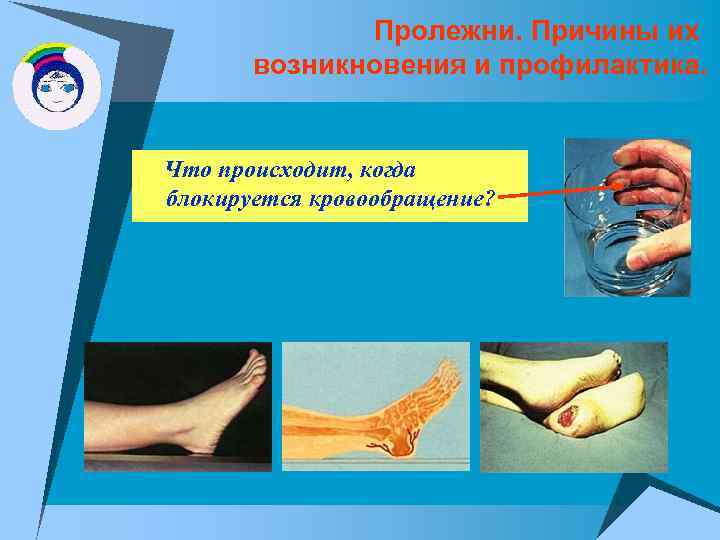 Пролежни. Причины их возникновения и профилактика. Что происходит, когда блокируется кровообращение? 