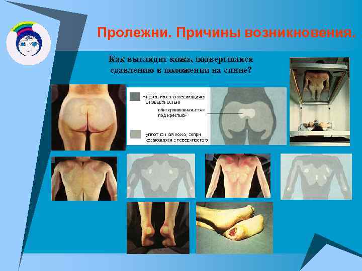 Пролежни. Причины возникновения. Как выглядит кожа, подвергшаяся сдавлению в положении на спине? 