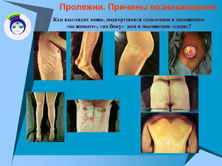 Пролежни. Причины возникновения. Как выглядит кожа, подвергшаяся сдавлению в положении «на животе» , «на