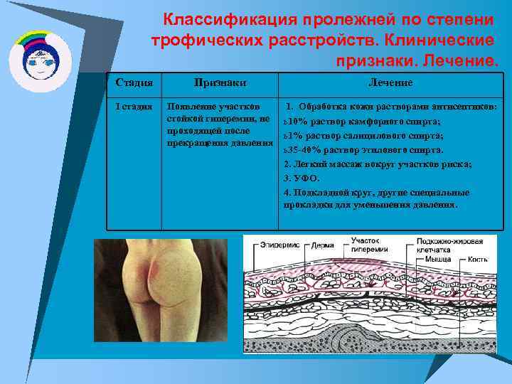 Классификация пролежней по степени трофических расстройств. Клинические признаки. Лечение. Стадия I стадия Признаки Лечение