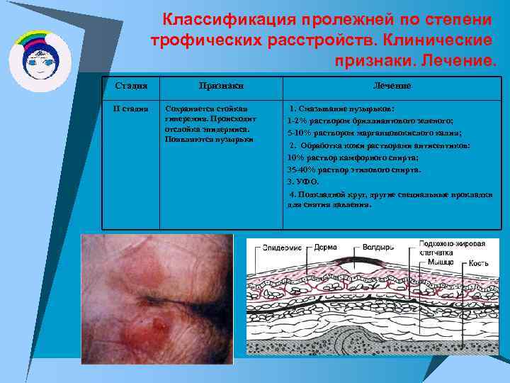 Классификация пролежней по степени трофических расстройств. Клинические признаки. Лечение. Стадия II стадия Признаки Сохраняется