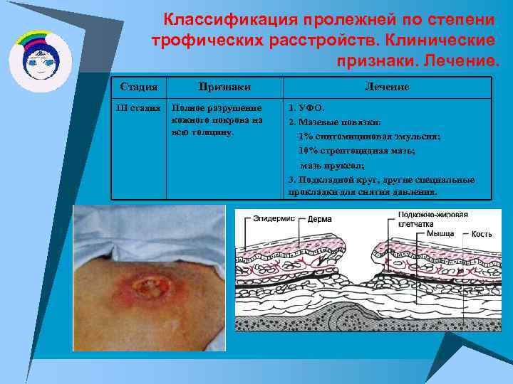 Классификация пролежней по степени трофических расстройств. Клинические признаки. Лечение. Стадия III стадия Признаки Полное