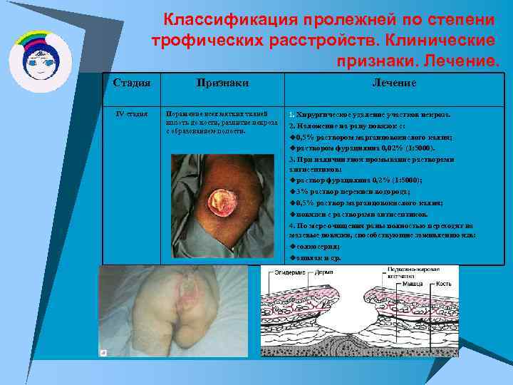 Классификация пролежней по степени трофических расстройств. Клинические признаки. Лечение. Стадия Признаки IV стадия Поражение