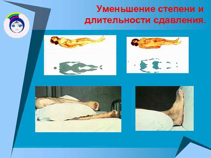 Уменьшение степени и длительности сдавления. 