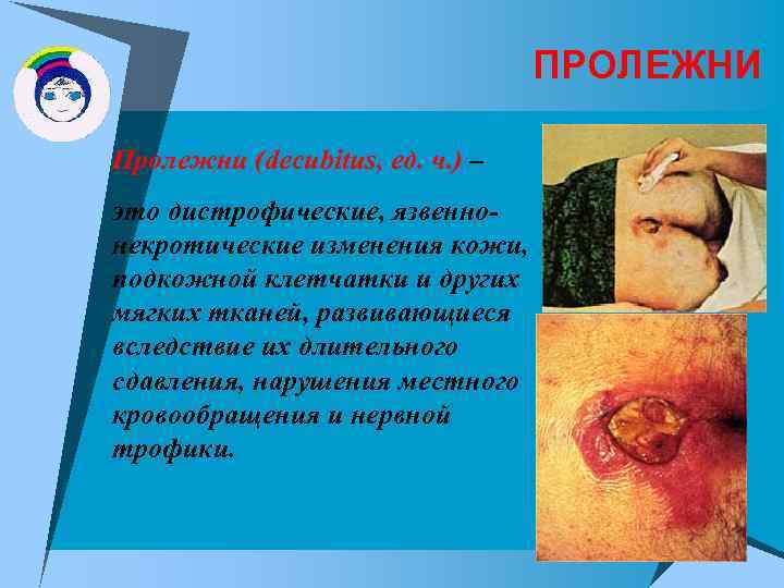 ПРОЛЕЖНИ Пролежни (decubitus, ед. ч. ) – это дистрофические, язвеннонекротические изменения кожи, подкожной клетчатки