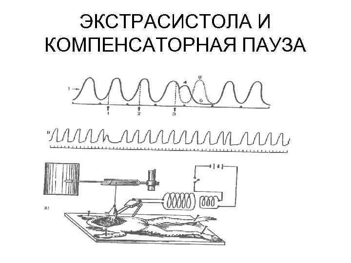 ЭКСТРАСИСТОЛА И КОМПЕНСАТОРНАЯ ПАУЗА 