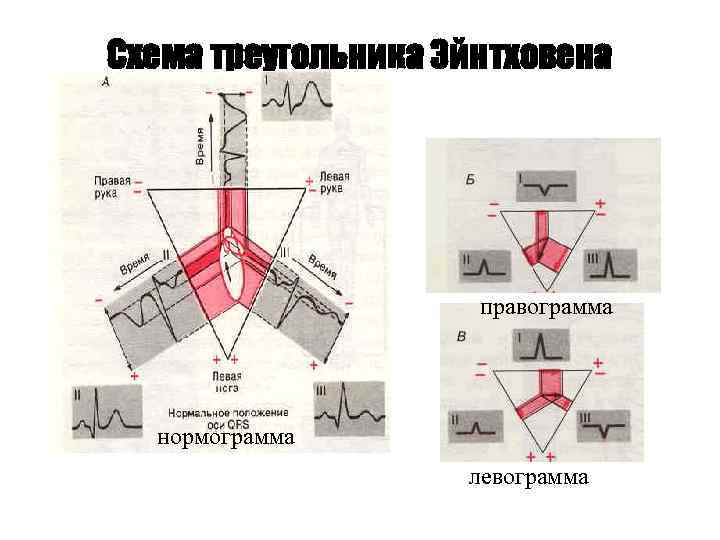 Схема треугольника Эйнтховена правограмма нормограмма левограмма 