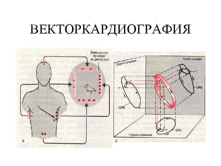 ВЕКТОРКАРДИОГРАФИЯ 