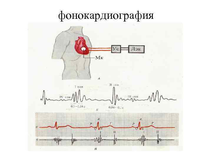 фонокардиография 