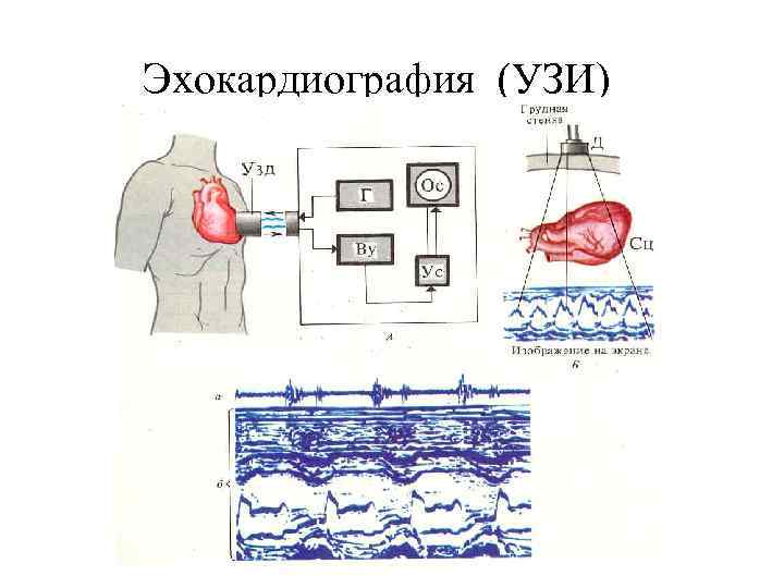 Эхокардиография (УЗИ) 