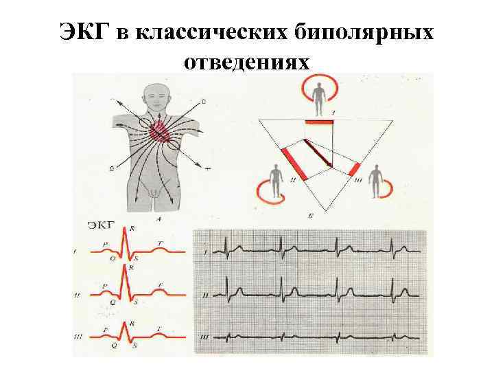 ЭКГ в классических биполярных отведениях 