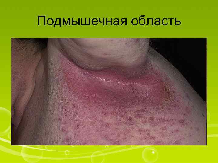 Подмышечная область 
