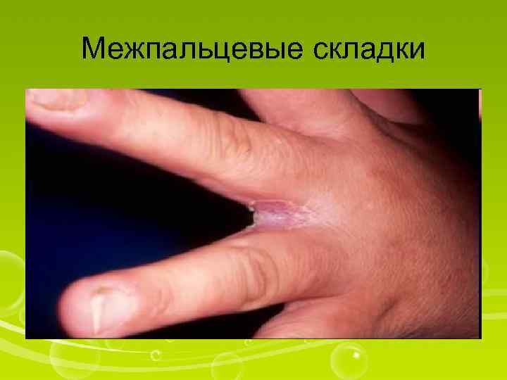 Межпальцевые складки 