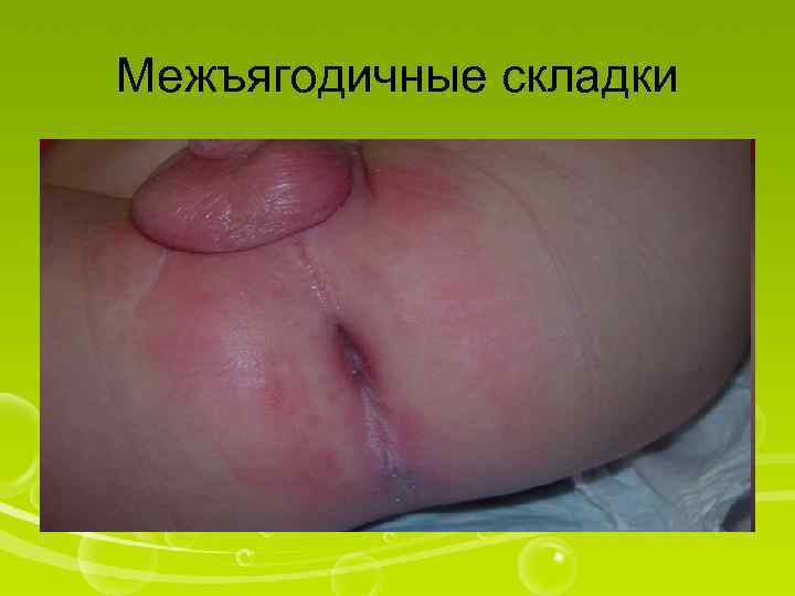 Межъягодичные складки 