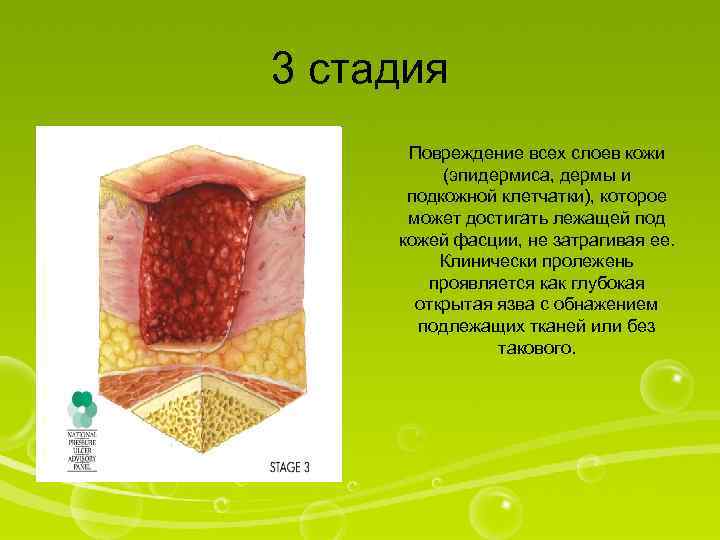 3 стадия Повреждение всех слоев кожи (эпидермиса, дермы и подкожной клетчатки), которое может достигать