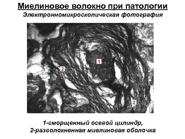 Миелиновое волокно при патологии Электронномикроскопическая фотография 1 2 2 1 -сморщенный осевой цилиндр, 2