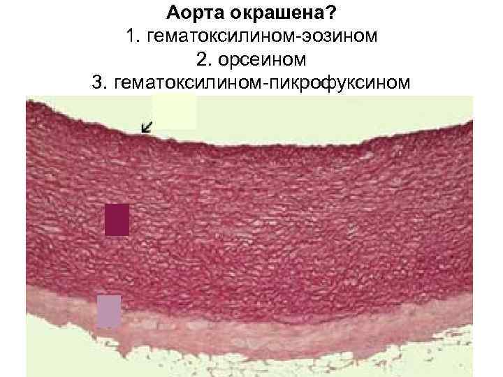 Аорта окрашена? 1. гематоксилином-эозином 2. орсеином 3. гематоксилином-пикрофуксином 