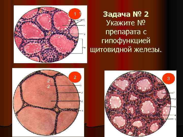 Щитовидная железа препарат. Гипофункция щитовидной железы препарат гистология. Гипофункция и гиперфункция щитовидной железы гистология. Щитовидная железа гипофункция гистопрепарат. Гиперфункция щитовидной железы гистология.