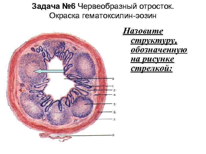 Задача № 6 Червеобразный отросток. Окраска гематоксилин-эозин Назовите структуру, обозначенную на рисунке стрелкой: 