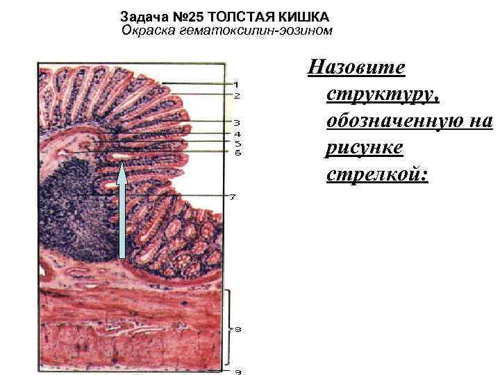 Задача № 25 ТОЛСТАЯ КИШКА Окраска гематоксилин-эозином Назовите структуру, обозначенную на рисунке стрелкой: 