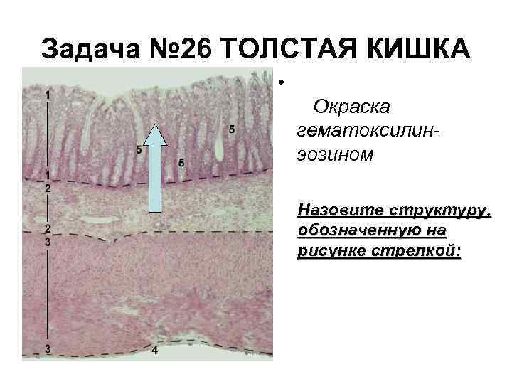 Задача № 26 ТОЛСТАЯ КИШКА • Окраска гематоксилинэозином Назовите структуру, обозначенную на рисунке стрелкой: