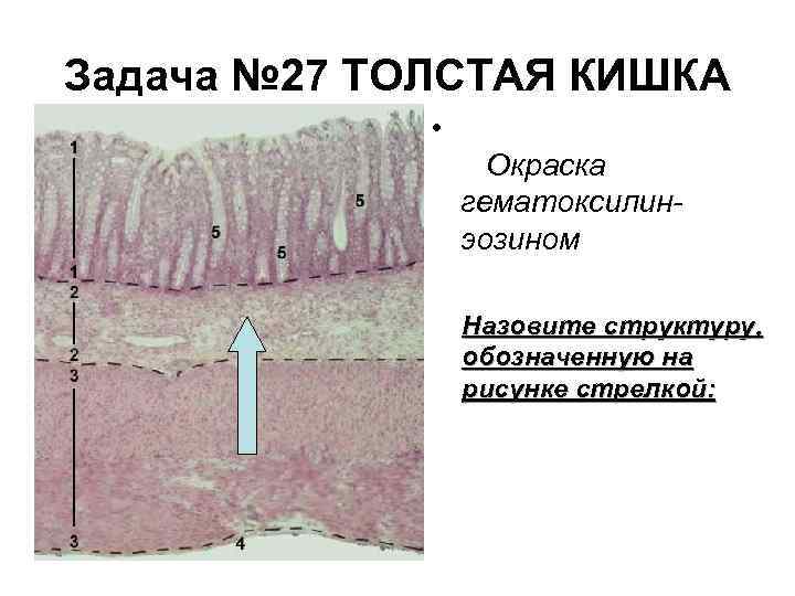 Задача № 27 ТОЛСТАЯ КИШКА • Окраска гематоксилинэозином Назовите структуру, обозначенную на рисунке стрелкой: