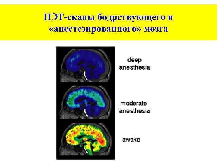 ПЭТ-сканы бодрствующего и «анестезированного» мозга 