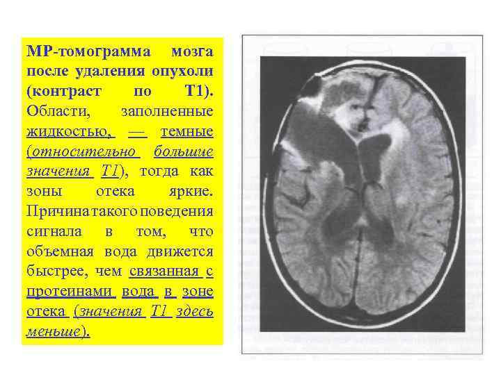 МР-томограмма мозга после удаления опухоли (контраст по Т 1). Области, заполненные жидкостью, — темные