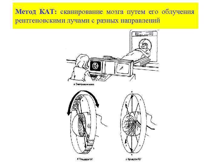 Метод КАТ: сканирование мозга путем его облучения рентгеновскими лучами с разных направлений 