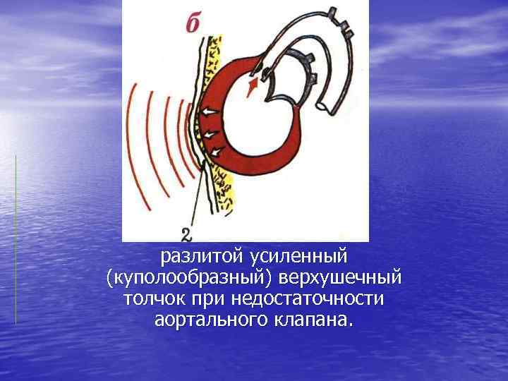 разлитой усиленный (куполообразный) верхушечный толчок при недостаточности аортального клапана. 