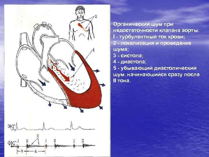 Органический шум при недостаточности клапана аорты. I - турбулентный ток крови; 2 - локализация