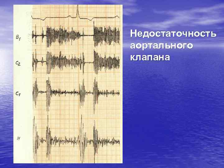 Недостаточность аортального клапана 