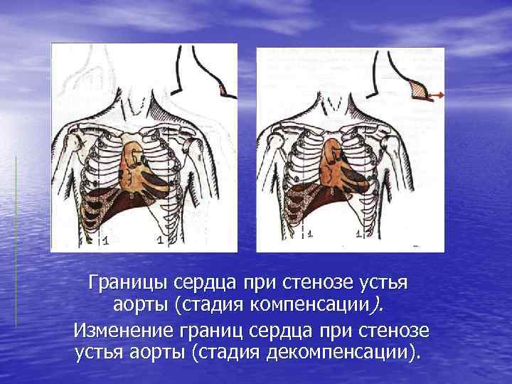 Границы сердца при стенозе устья аорты (стадия компенсации). Изменение границ сердца при стенозе устья