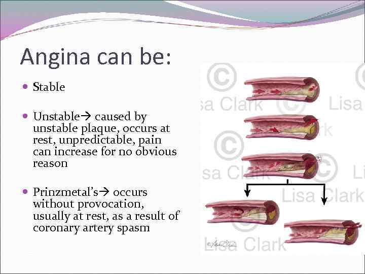 Angina can be: Stable Unstable caused by unstable plaque, occurs at rest, unpredictable, pain