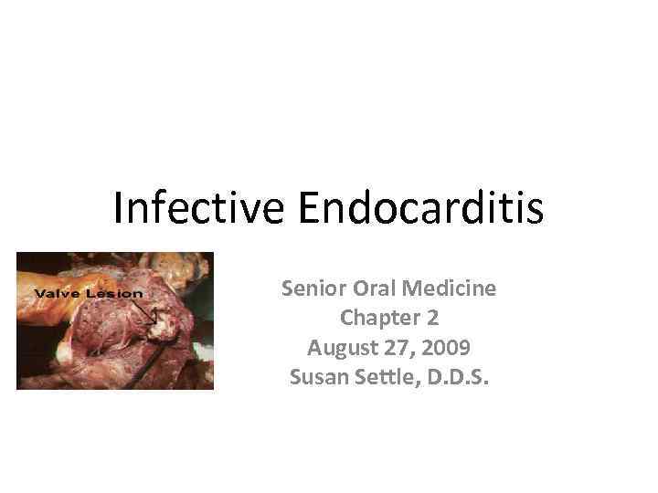 Infective Endocarditis Senior Oral Medicine Chapter 2 August 27, 2009 Susan Settle, D. D.