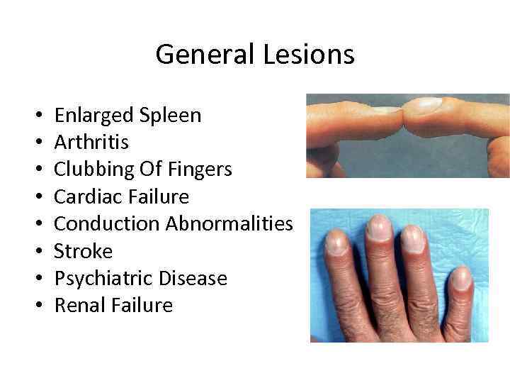 General Lesions • • Enlarged Spleen Arthritis Clubbing Of Fingers Cardiac Failure Conduction Abnormalities