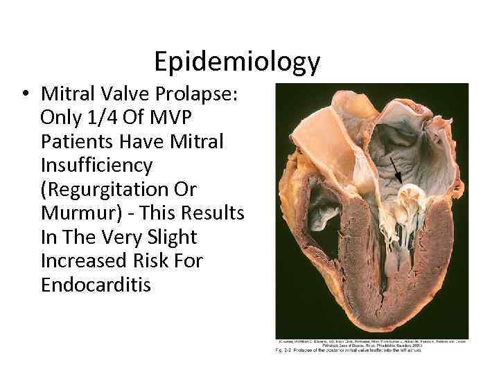 Epidemiology • Mitral Valve Prolapse: Only 1/4 Of MVP Patients Have Mitral Insufficiency (Regurgitation