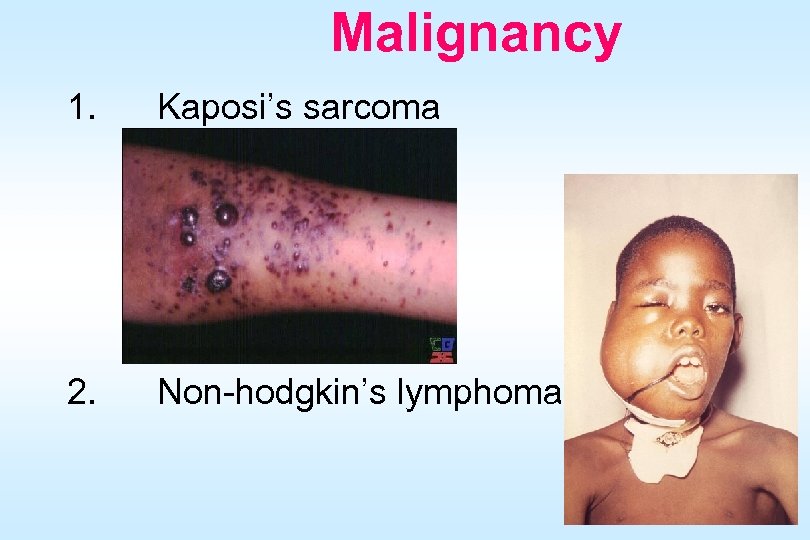 Malignancy 1. Kaposi’s sarcoma 2. Non-hodgkin’s lymphoma 