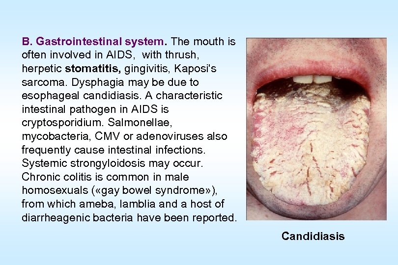 B. Gastrointestinal system. The mouth is often involved in AIDS, with thrush, herpetic stomatitis,